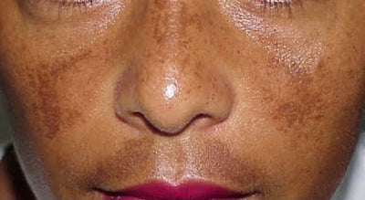 What is THAT on my skin?! Day 3: Melasma.