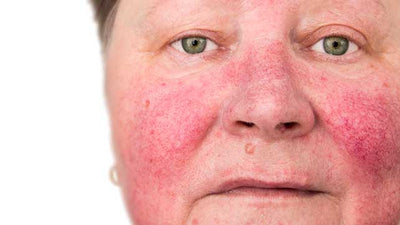 You have Rosacea; you’re not alone.